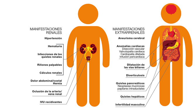 La Poliquistosis Renal Autosómica Dominante afecta a los riñones y a otros órganos.