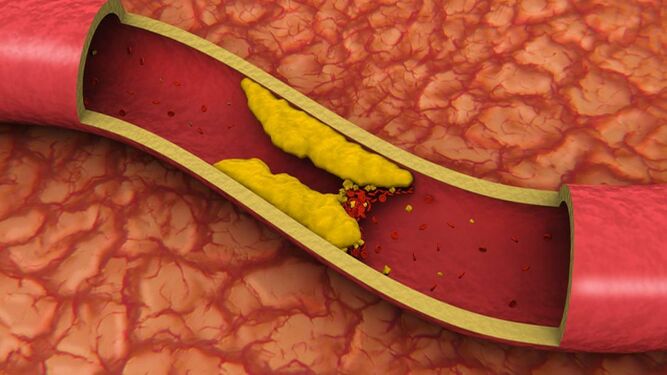 La grasa que se acumula en las arterias en realidad puede mantenerlas sanas
