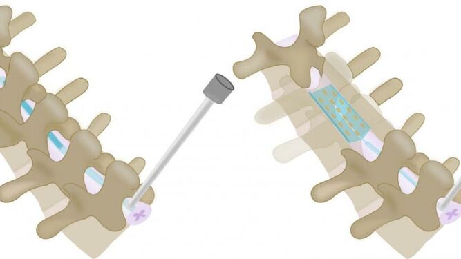 Un dispositivo inyectable para acabar con el dolor crónico sin cirugía